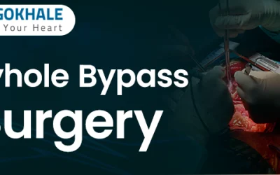 Key Hole Bypass Surgery